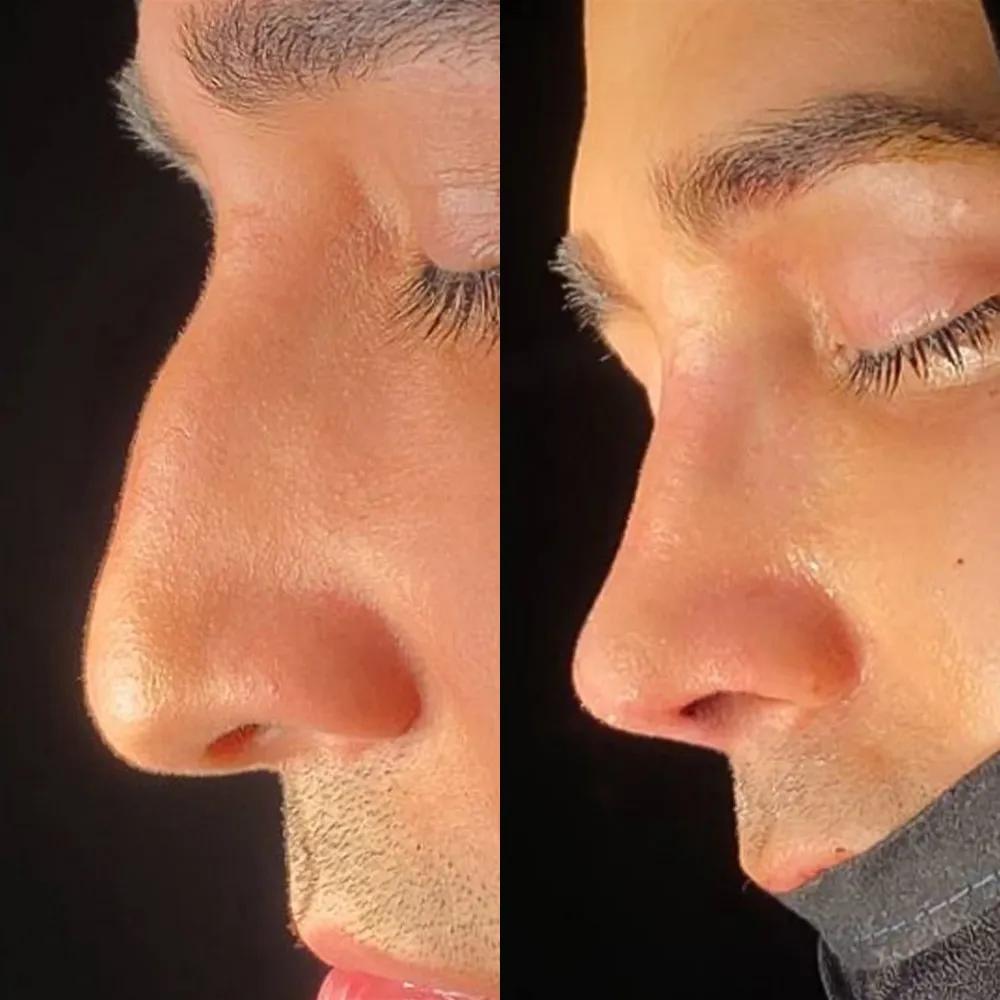 Rhinoplasty Packages in Iran