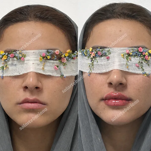 Facial Aesthetics in iran