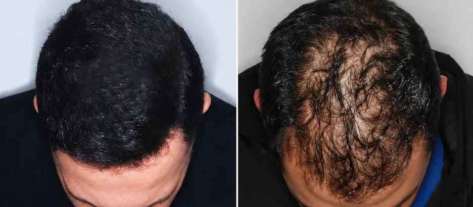 Hair Transplant