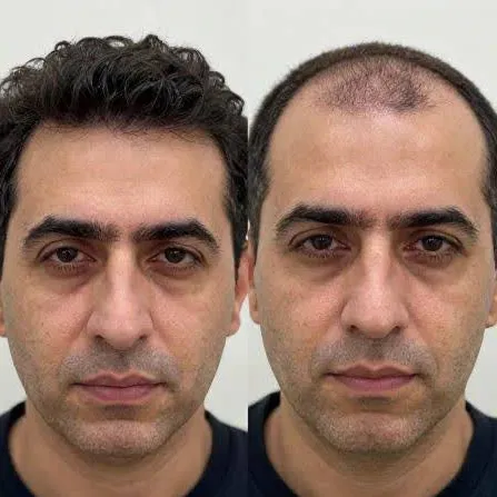 Hair Transplant